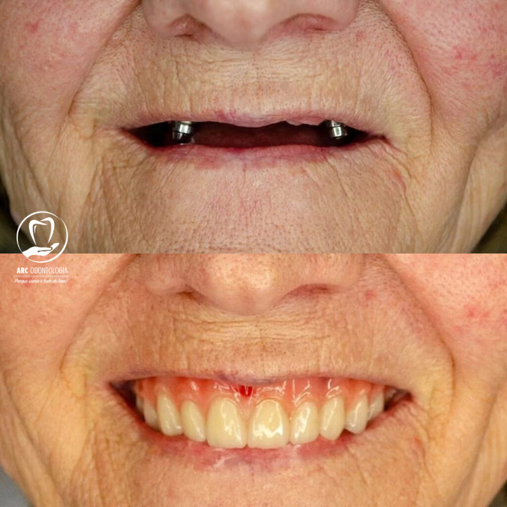 Antes e depois implantodontia