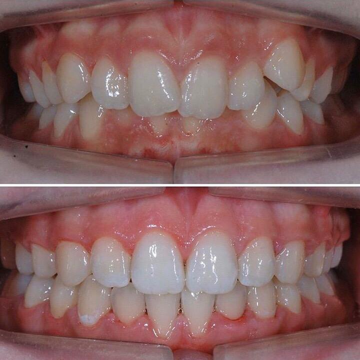 Antes e depois ortodontia
